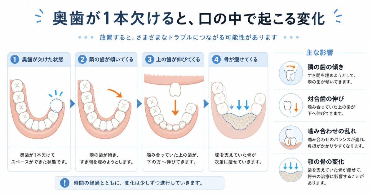 奥歯が1本抜けた放置のリスクとは?噛み合わせや顎の不調を解説