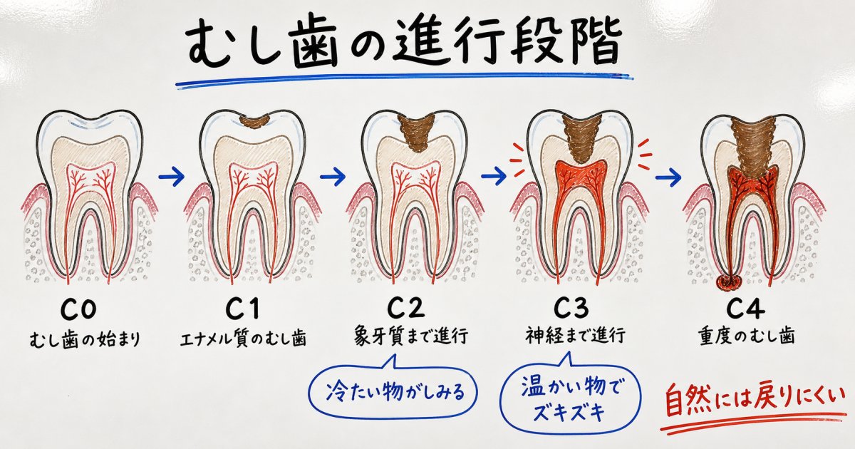 温かい物がしみるのはなぜ？むし歯の進行段階と神経への影響