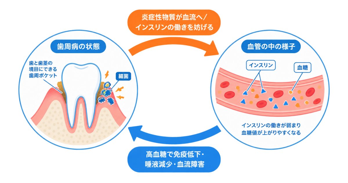 血糖値と歯周病はなぜ悪循環を起こすのか
