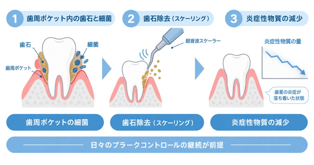 歯周病治療は血糖コントロールの改善に役立つのか