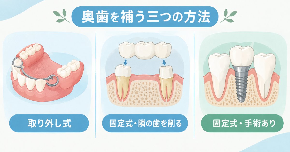 噛み心地・残る歯への負担・手術の有無で見る三つの方法